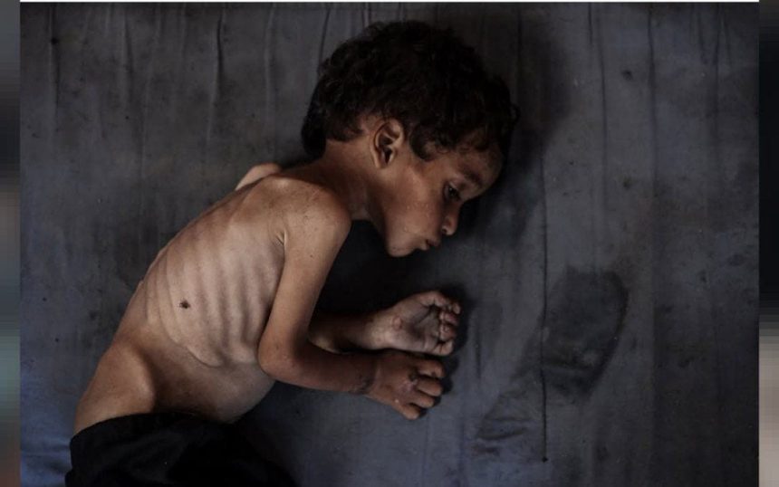 صحة غزة: ارتفاع حصيلة شهداء الجوع في غزة إلى 180 بينهم 93 طفلا