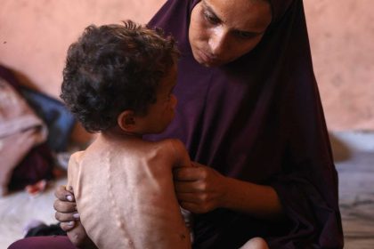 وباء جديد يضرب غزة: فيروس قاتل يشبه كورونا يفتك بالأطفال الجوعى