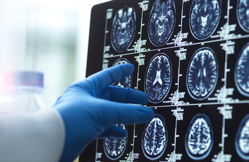 الإمارات تطلق أول تجربة سريرية لتقنية "الذكريات الاصطناعية" لدعم مرضى الزهايمر والخرف
