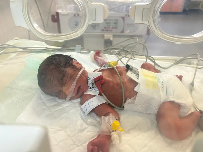 بسبب تداعيات الحرب.. ارتفاع أعداد تشوهات المواليد في غزة